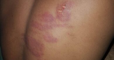 Joven que fue golpeado por agentes policiales en Villas Agrícolas presenta dificultad de salud