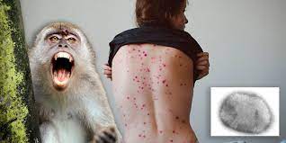 Viruela del mono: qué dice la OMS acerca de los 80 casos confirmados en Europa y América del Norte