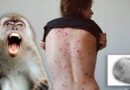 Viruela del mono: quiénes tienen un mayor riesgo de contagio y cuáles están protegidos