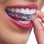 Retenedores dentales: ¿qué tipos existen y cuáles son sus beneficios?