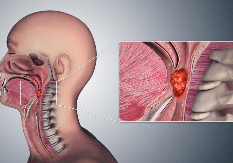 La infección por el VPH puede causar cáncer de boca y de garganta