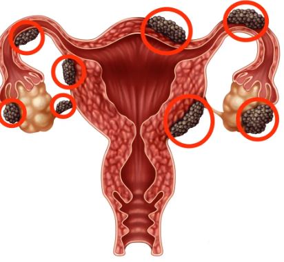 Una muestra de orina puede servir para diagnosticar el cáncer de endometrio
