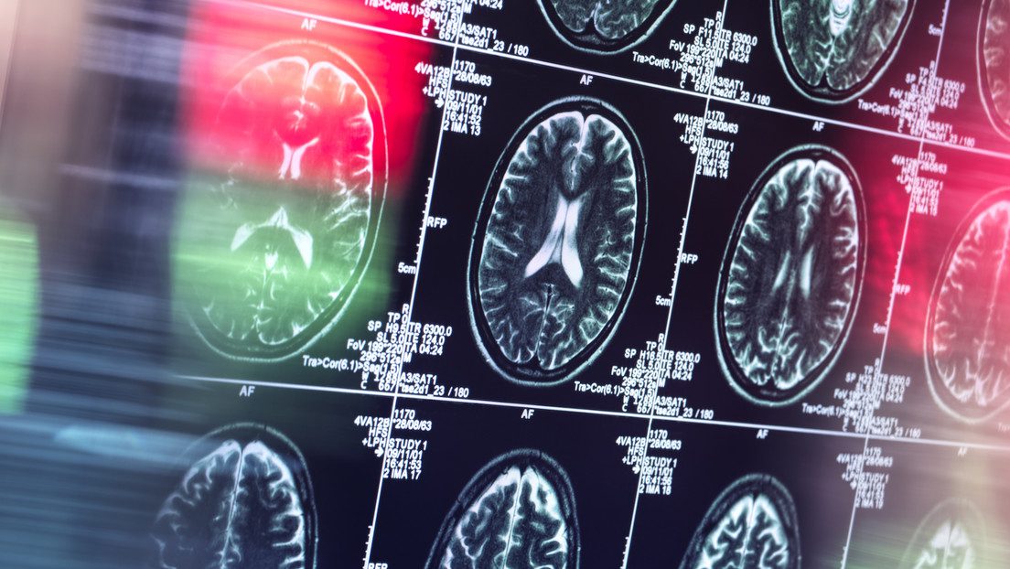 Un nuevo fármaco ralentiza el deterioro cognitivo por el alzhéimer en su etapa temprana (pero tiene efectos secundarios)