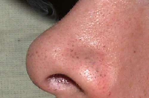 Tips para eliminar los puntos negros del rostro con rapidez