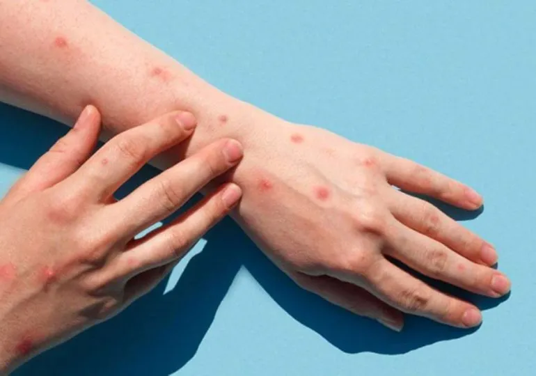 La OMS preocupada por una nueva cepa de la viruela del mono