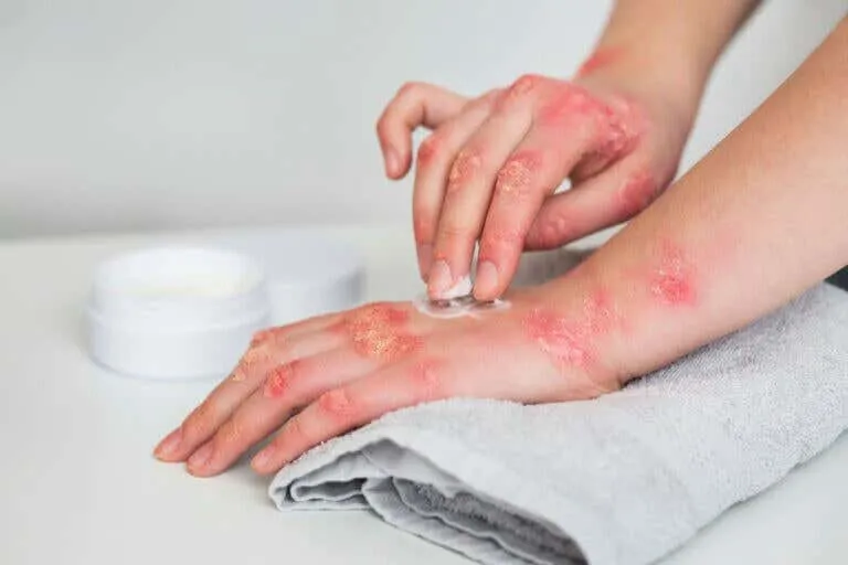 Qué es la psoriasis nerviosa y cómo identificarla