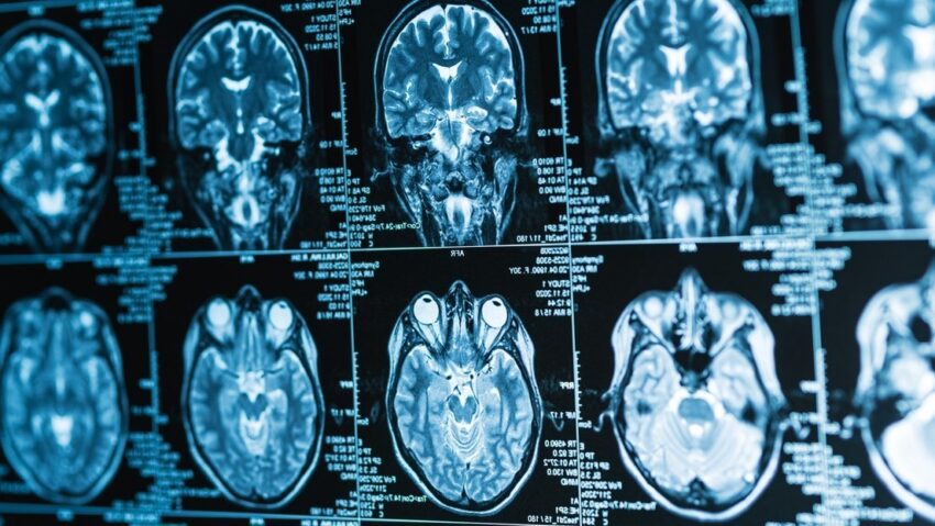 Desarrollan un implante cerebral capaz de transformar pensamientos en palabras en tiempo real.