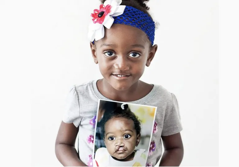 Fundación Operación Sonrisa República Dominicana realizará jornada quirúrgica gratuita de Labio y Paladar Hendido