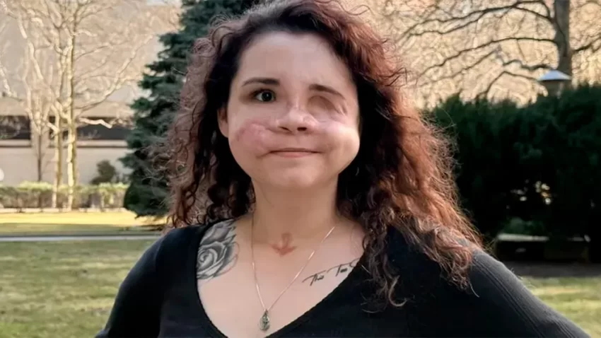 Sobrevive a un balazo, supera 37 cirugías y ahora vuelve a comer como antes