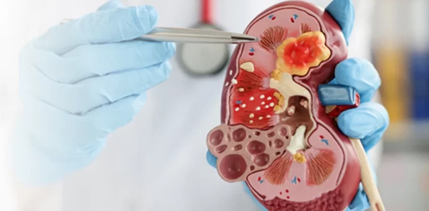 Enfermedad renal diabética; ¿qué es y cómo prevenirla?