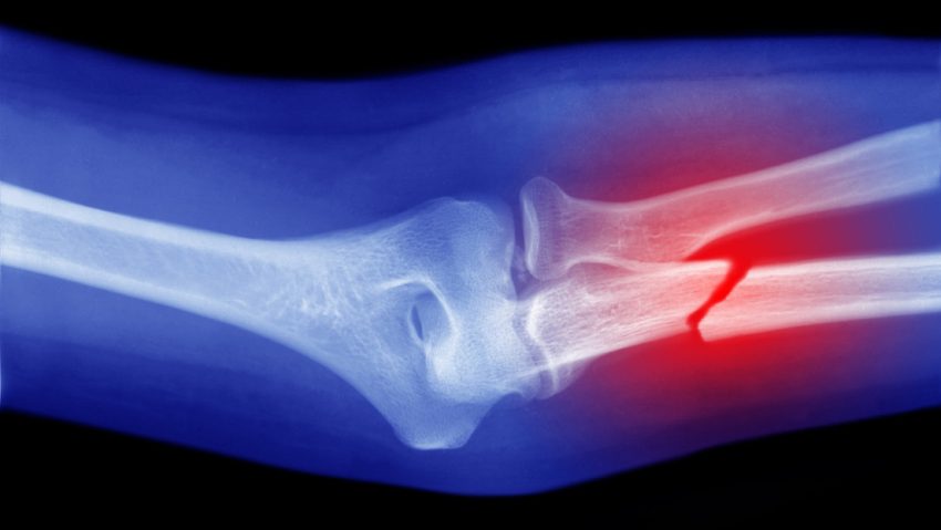 Células capaces de 'convertirse en hueso' podrían ser la clave para curar fracturas graves