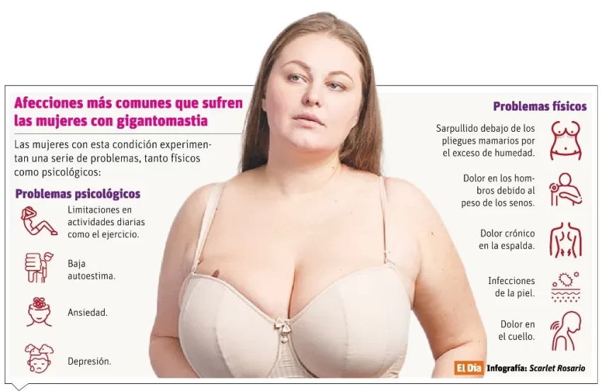 Gigantomastia, condición que afecta salud física y emocional de la mujer