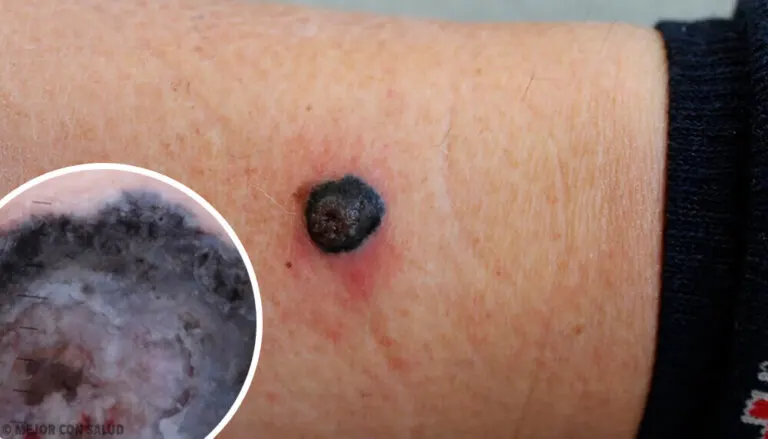 Melanoma maligno