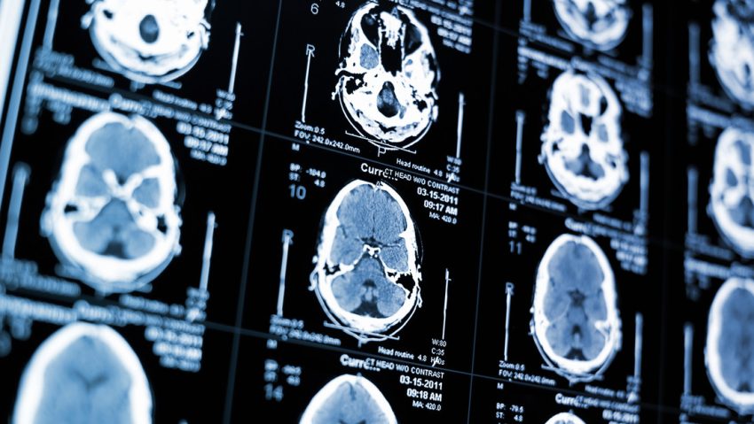 La forma del cerebro podría revelar los primeros signos de esta grave enfermedad