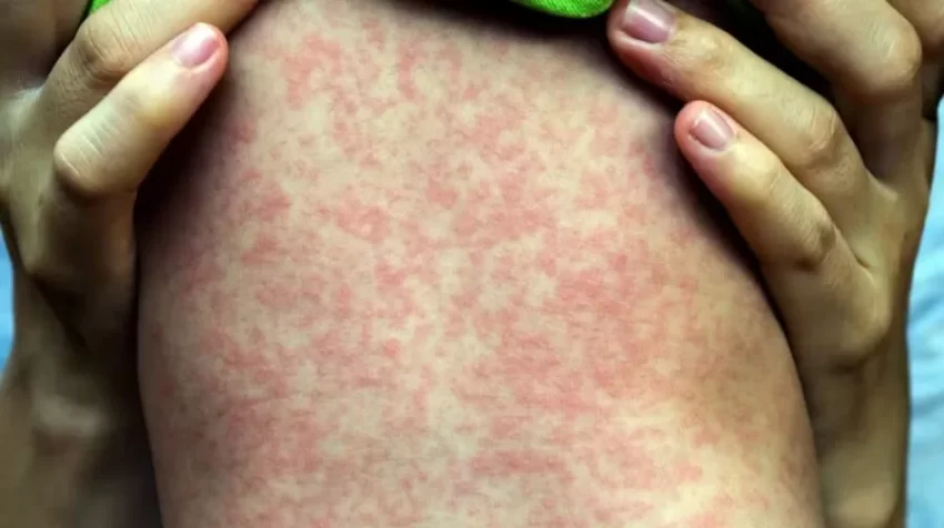 Sarampión se dispara en EE.UU; primer caso en NY de virus Chikungunya