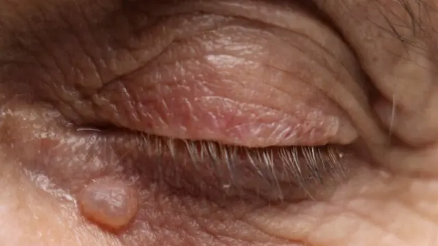 Verrugas en los párpados: por qué se forman y cómo se pueden eliminar