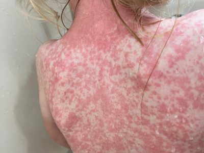 Sarampión en RD: un brote a la vista