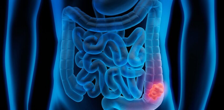 ¿Menores de 50 años con cáncer colorrectal? La nueva realidad