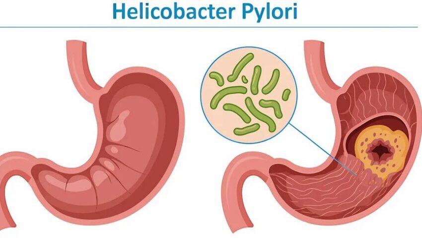 Helicobacter pylori estaría asociado al cáncer colorrectal
